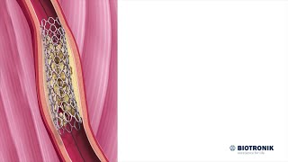 Angioplastica e stenting  Animazione medica [upl. by Naul]