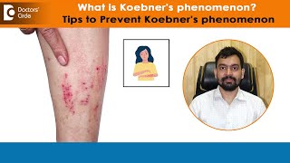 After Skin InjuiryKOEBNERS or ISOMORPHIC Phenomenon amp PreventionDrRajdeep MysoreDoctors Circle [upl. by Obeng]