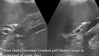 Case 519 Post cholecystectomy syndrome PCS residual gall bladder stone in remenant of cystic duct [upl. by December]