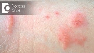 How to manage Parapsoriasis amp white spots after contacting nickel  Dr Rasya Dixit [upl. by Nomolos]