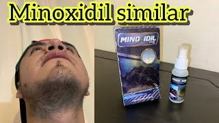 Minoxidil similar 2024  a prueba durante 1 año [upl. by Aivatahs]