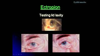 A Class On Ectropion By Dr VivekanandDept Of Ophthalmology [upl. by Asille605]