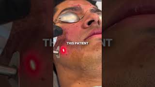 How to treat Icepick  Boxcar Acne Scars acnescarsremoval acnescartreatment [upl. by Ynnavoeg]