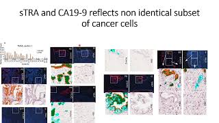 sTRA amp CA199 glycans express nonidentical subset of pancreatic cancer cell populations Code 695 [upl. by Lehte]