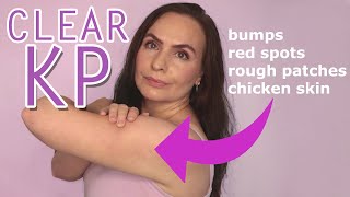 2 Simple Steps to Get Rid of KP Keratosis Pilaris Bumps [upl. by Augustina]