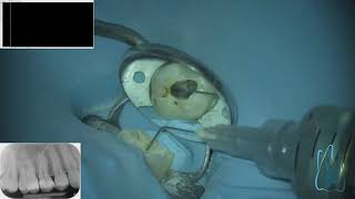 LIVE ENDODONTIC TREATMENT  first upper molar 40 minutes 4 canals [upl. by Otilrac]