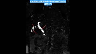 MRI case 65 Choledocholithiasis and cholelithiasis MRCPradiology mri radiologist mrcp [upl. by Lepper]