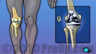 Knee Replacement Surgery PreOp® Patient Education [upl. by Meingoldas]