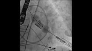 TAVRTranscatheter Aortic Valve Replacement Transapical Deployment [upl. by Anoj]