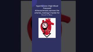 ATHEROSCLEROSIS nclex rn nursing nursingfoundation atherosclerosis healthawreness medical [upl. by Aikkin]