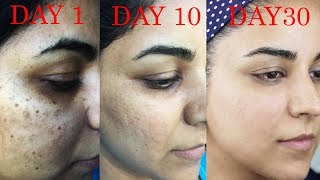 How I Got Rid of Dark Scars Hyperpigmentation PimplesAcne [upl. by Notgnillew426]