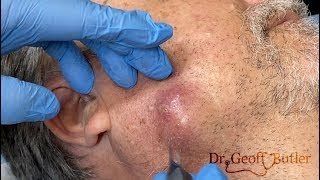 Drainage of an infected cyst along the jaw line [upl. by Allenod]