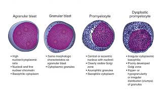 Myelodysplastic Syndrome [upl. by Avril]