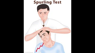 Spurling Test [upl. by Linnea348]