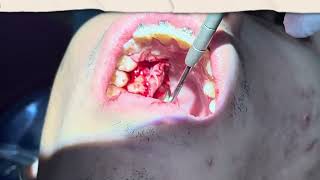 Extra tooth in the Upper Removal under 2mins actual time [upl. by Anawot]