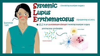 Systemic Lupus Erythematosus  signs and symptoms pathophysiology and diagnosis of Systemic Lupus [upl. by Malcom]