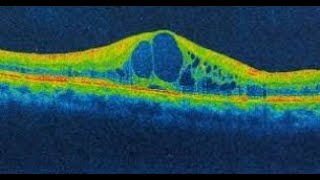 Cystoid Macular Edema [upl. by Thema71]