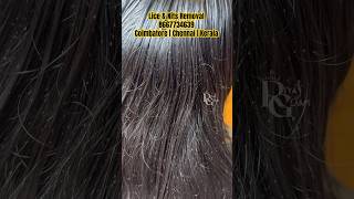 Lice nits removal treatment in parlour Tamilhoe to remove nits from hairlice removalhow to [upl. by Negris89]