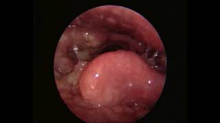 Laryngeal Tuberculosis [upl. by Evreh921]