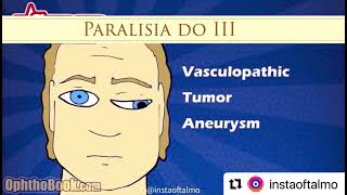 Paralisia do terceiro nervo craniano Third nerve palsy [upl. by Robbert]