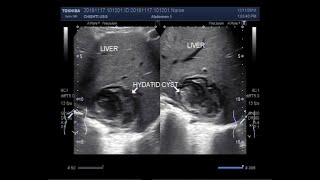 Ultrasound Video showing Hepatic hydatid cyst [upl. by Itram]