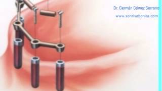 implantes dentales explicacion facil de entender  vídeo para pacientes [upl. by Raymund485]