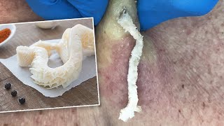 Gritty TripeLike Cyst Squeezed Out  CONTOUR DERMATOLOGY [upl. by Ibrek]