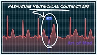 Premature Ventricular Contrcations Ventricular Bigeminy Trigeminy Quadrigeminy [upl. by Mccall]