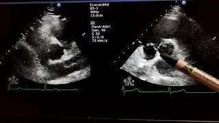 Valvula aortica Aorta bivalva Ecocardiograma Cardiologia Puerto Vallarta [upl. by Segalman]