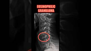 Eosinophilic Granuloma bones radiology doctor [upl. by Freud]