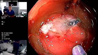 colon polype evaluation amp management [upl. by Noicpecnoc]