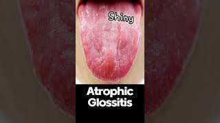 Atrophic Glossitis  Symptoms and Causes shorts [upl. by Buchheim]