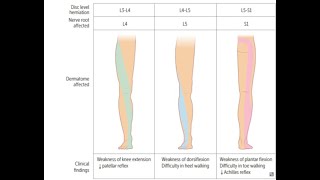 Lumbosacral radiculopathy [upl. by Ahsitneuq748]