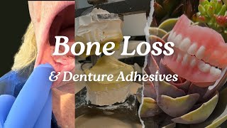 Denture Adhesives and Bone loss [upl. by Margaret480]