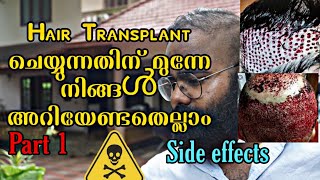 അറിയണം Side effects of Hair Transplantation in Malayalam problem faced after hairbeard transplant [upl. by Weirick]