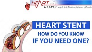 Heart Stent  How do you know if you need one [upl. by Nnair826]