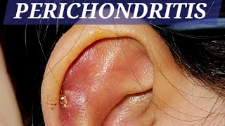 perichondritis earpain swelling treatment drbaisalisarkar ENTSurgeon kolkata [upl. by Iak]