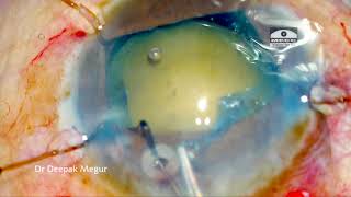 Capsule Tension Ring CTR part 3 final CTR in SICS case Dr Deepak Megur [upl. by Eglantine]