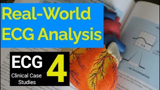 RealWorld ECG Analysis 4 Clinical Case Studies in Electrocardiography [upl. by Wyn]