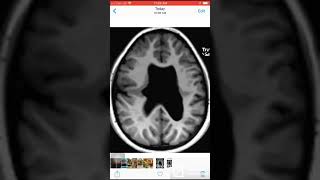 Case 036 Closed lip Schizencephaly and absent septum pellucidum [upl. by Nyladnewg]