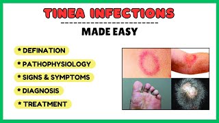 Tinea infection fungal skin infection types of tinea pathophysiology diagnosis treatment [upl. by Aikenat]