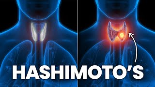 How To Stop Hashimoto’s From Turning Into Hypothyroidism [upl. by Nosyerg]