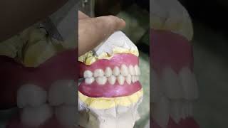 Complete Denture Ready for Flasking After Try In completedenture fulldenture [upl. by Haonam]