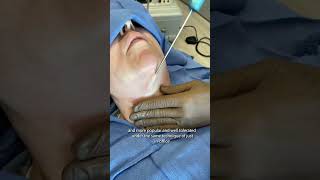 Dr Schneider performs inoffice chin liposuction [upl. by Aiekat893]