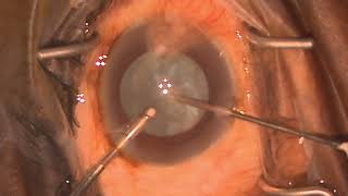 AJO  Video IampA decompression of intumescent cataract Deshmukh’s Technique [upl. by Jarrid]