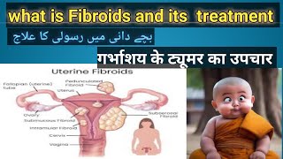 What is Fibroids  Fibroids Symptoms and Fibroids Treatment  Fibroids  Health and fitness tips [upl. by Elsilrac]