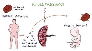 Understanding Rhesus Status and AntiD in Pregnancy [upl. by Lyckman]