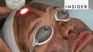 Get Glowing Skin With A Laser Facial [upl. by Nylirek]