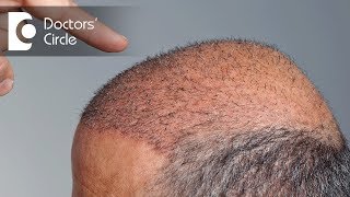 When will newly transplanted hair start to grow  Dr Niranjana Raj [upl. by Anesusa]