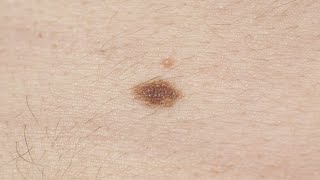 Melanoma symptoms How to spot signs and when to see a doctor [upl. by Yeknarf486]